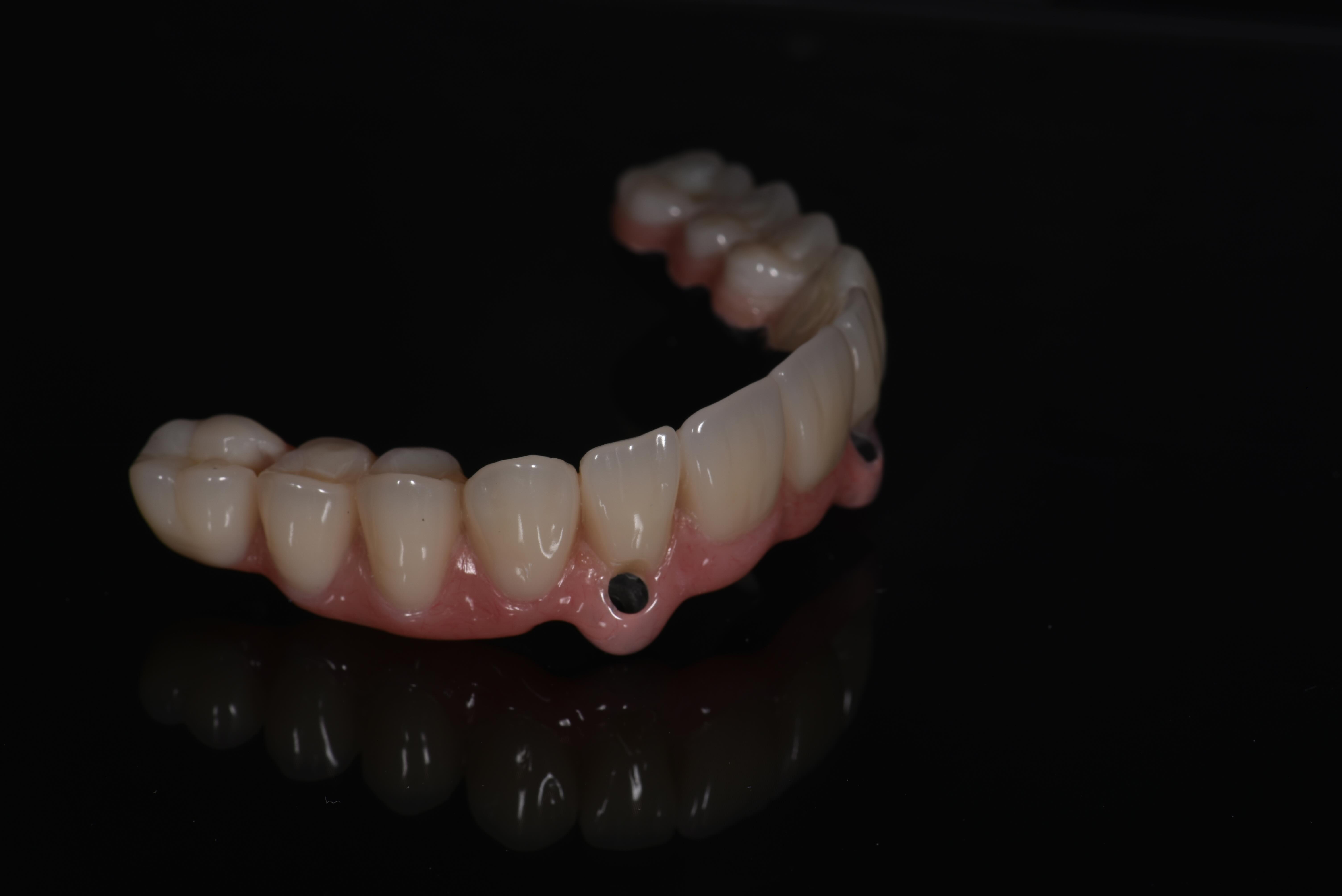 implantáty Branemark můstky